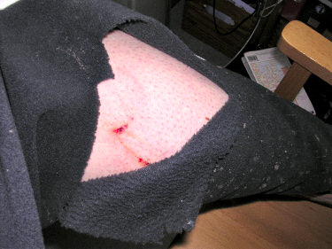 Picture of torn trousers with slightly bloody leg